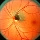 Melanocytoma Melanocytoma